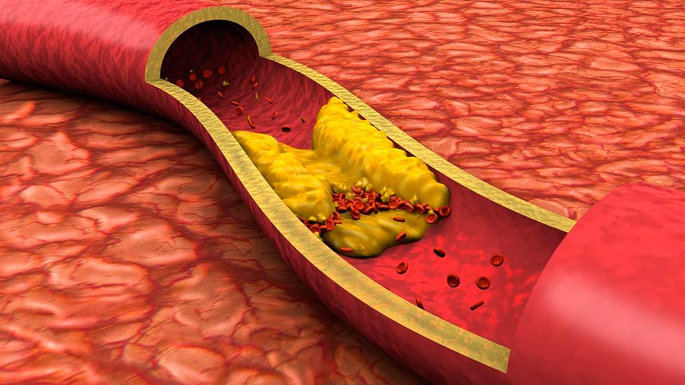 Cholesterol