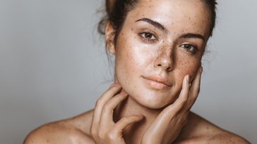 Пигментные пятна: что это такое и какие существуют виды 11 Dark spots