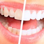 Как отбелить зубы: виды, преимущества и недостатки 17 Teeth whitening
