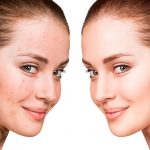 Акне: топ-7 полезных советов, которые помогут избавиться от проблемы 19 Acne