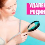 Родинки на теле: оставить или удалить? 14 Mole removal