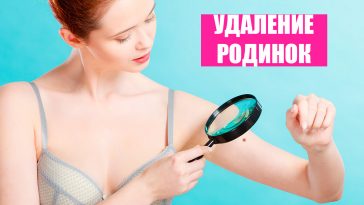 Родинки на теле: оставить или удалить? 3 Mole removal