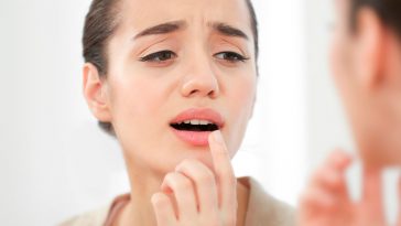 Герпес на губах: причины, симптомы и способы лечения 5 Herpes on the lips