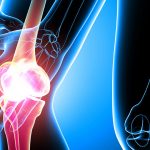 Артрит и артроз: в чем разница и как отличить эти заболевания 16 Arthritis and arthrosis