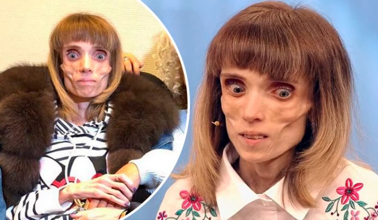 Весила 17 кг. Как сейчас выглядит и чем занимается победившая смертельную болезнь Кристина Корягина 6 Корягина