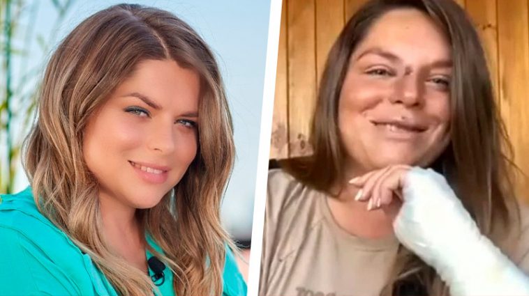 Разбитый нос и сломаная рука: ведущая 1+1 появилась в прямом эфире и ужаснула зрителей 6 6 19