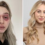 «Моя кожа превратилась в ужас»: Женщина рассказала как ее лицо исказилось после косметической процедуры 13 для харли1