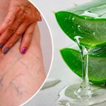 Устали от варикоза, тяжести в ногах и отёков? Попробуйте это простое средство с алоэ вера в домашних условиях! 🌿 17 Устали от варикоза, тяжести в ногах и отёков? Попробуйте это простое средство с алоэ вера в домашних условиях!