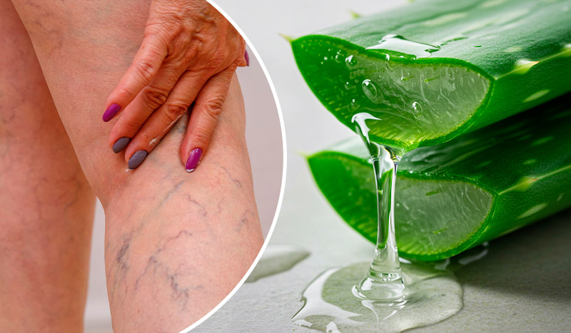 Устали от варикоза, тяжести в ногах и отёков? Попробуйте это простое средство с алоэ вера в домашних условиях!