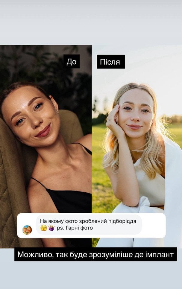 Жена Виктора Павлика поделилась трагическим опытом: неудачная коррекция подбородка 9 da10046cd668a0b763a6976e782afd83