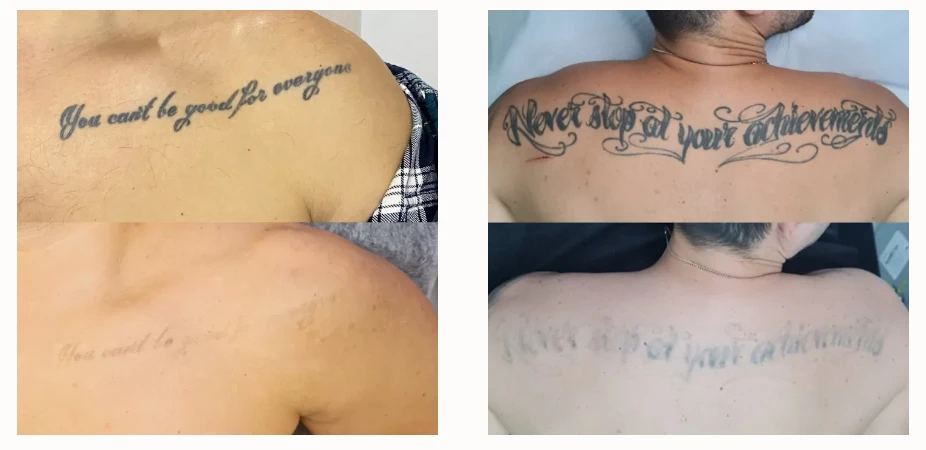 Как свести тату безопасно и без следов на коже